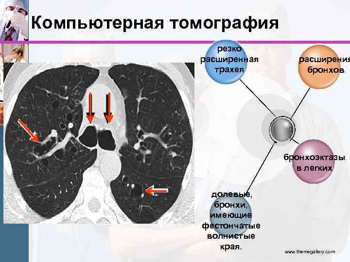 Кт бронхов. Кт лёгких и бронхов. Бронхи легких кт. Расширенные бронхи на кт.