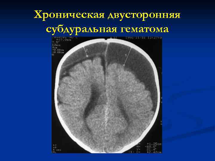 Хроническая двусторонняя субдуральная гематома 