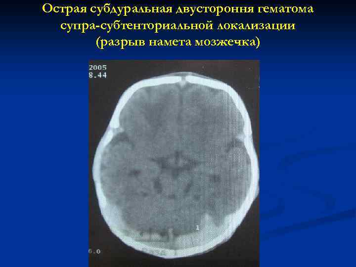 Острая субдуральная двустороння гематома супра-субтенториальной локализации (разрыв намета мозжечка) 