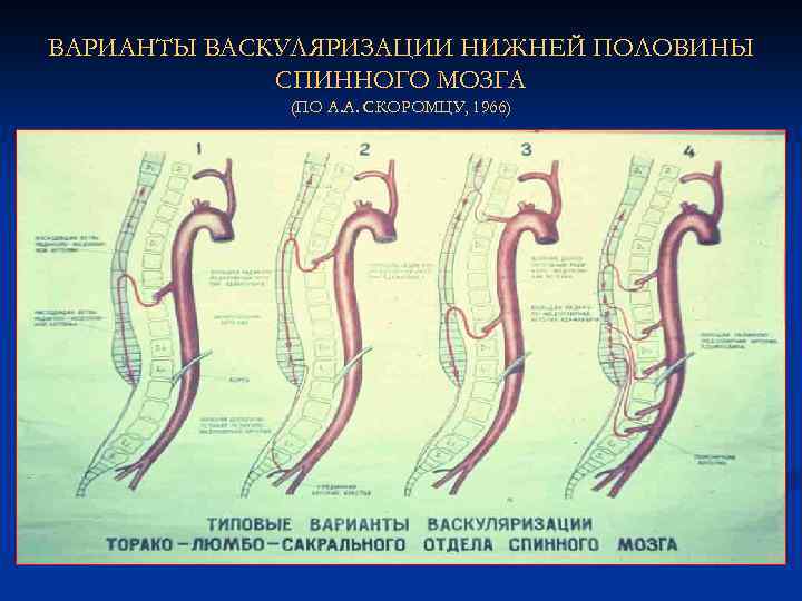 ВАРИАНТЫ ВАСКУЛЯРИЗАЦИИ НИЖНЕЙ ПОЛОВИНЫ СПИННОГО МОЗГА (ПО А. А. СКОРОМЦУ, 1966) 