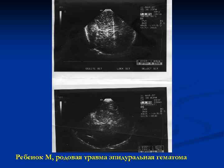 Ребенок М, родовая травма эпидуральная гематома 