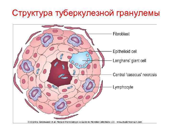 Структура туберкулезной гранулемы 