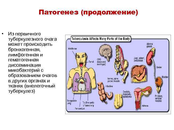 Патогенез (продолжение) • Из первичного туберкулезного очага может происходить бронхогенная, лимфогенная и гематогенная диссеминация