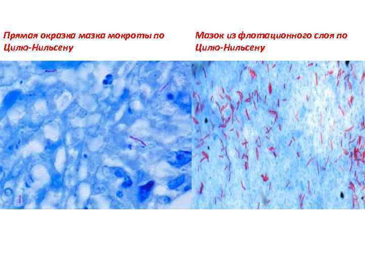 Прямая окразка мокроты по Цилю-Нильсену Мазок из флотационного слоя по Цилю-Нильсену 
