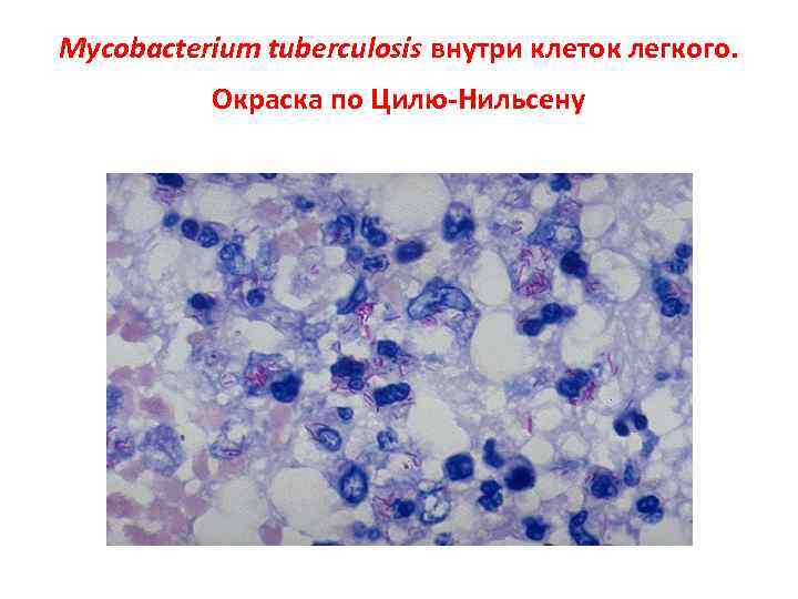 Mycobacterium tuberculosis внутри клеток легкого. Окраска по Цилю-Нильсену 