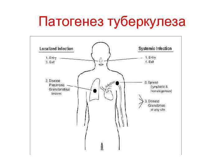 Патогенез туберкулеза 