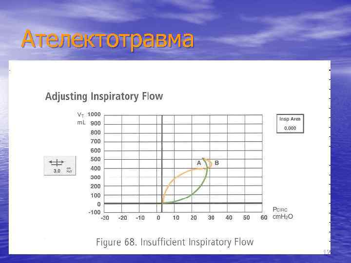 Ателектотравма 12 