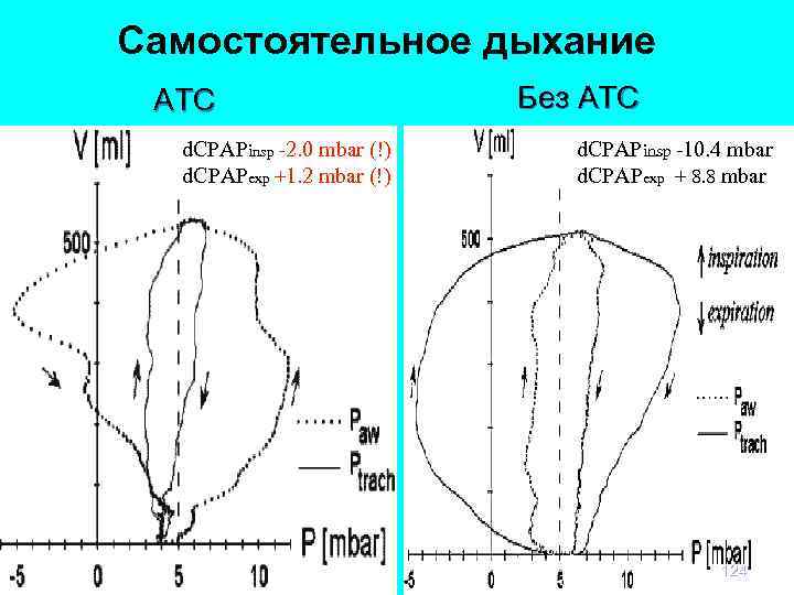Самостоятельное дыхание ATС d. CPAPinsp -2. 0 mbar (!) d. CPAPexp +1. 2 mbar