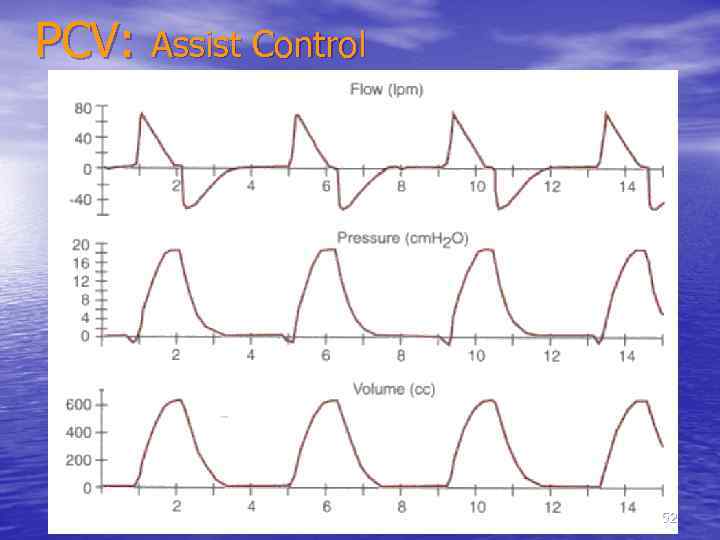 PCV: Assist Control 52 