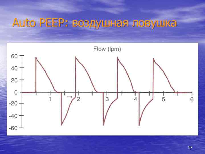 Auto PEEP: воздушная ловушка 87 