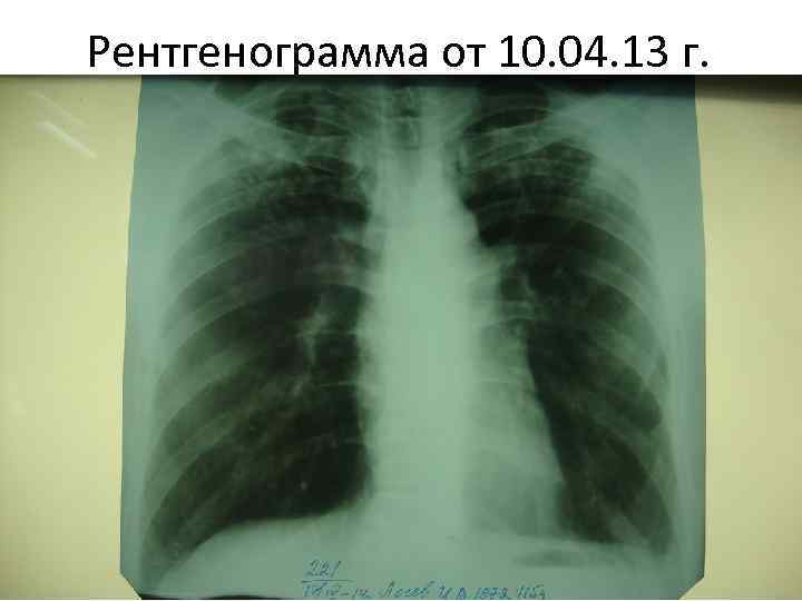 Рентгенограмма от 10. 04. 13 г. 