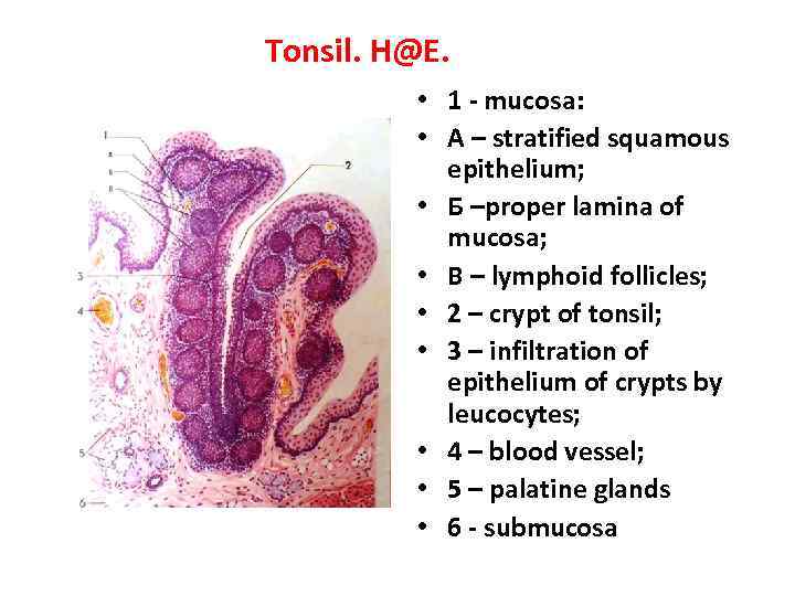 Tonsil. H@E. • 1 - mucosa: • A – stratified squamous epithelium; • Б