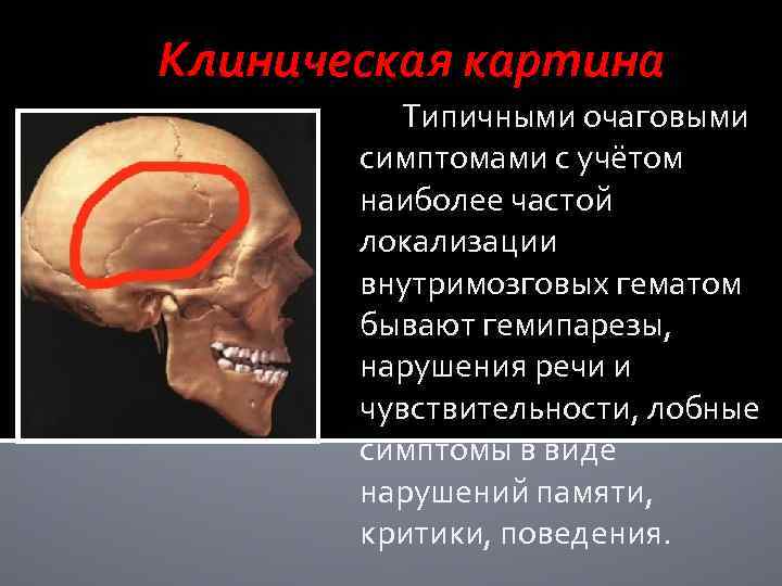 Клиническая картина Типичными очаговыми симптомами с учётом наиболее частой локализации внутримозговых гематом бывают гемипарезы,
