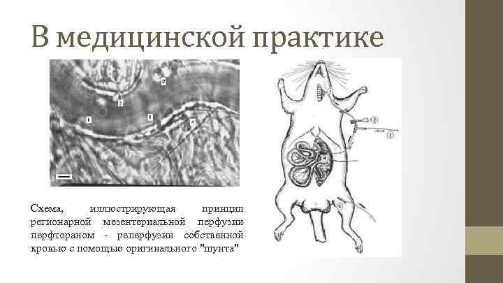 В медицинской практике Схема, иллюстрирующая принцип регионарной мезентериальной перфузии перфтораном - реперфузии собственной кровью