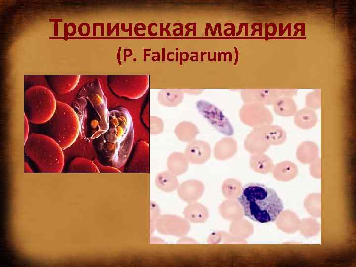 Тропическая малярия (P. Falciparum) 