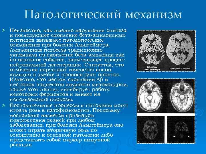 Патологический механизм Неизвестно, как именно нарушения синтеза и последующее скопление бета-амилоидных пептидов вызывает патологические
