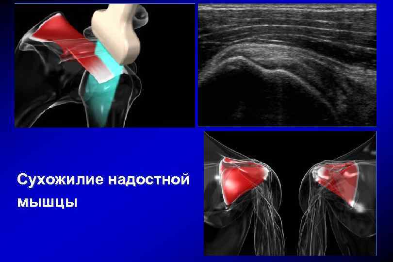 Операция разрыва сухожилия надостной мышцы. Разрыв сухожилия надостной мышцы плечевого сустава. Тендинит сухожилия надостной. Субтотальный разрыв сухожилия надостной мышцы плечевого сустава. Повреждение сухожилия надостной мышцы.