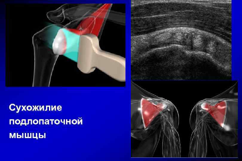 Сухожилие надостной мышцы