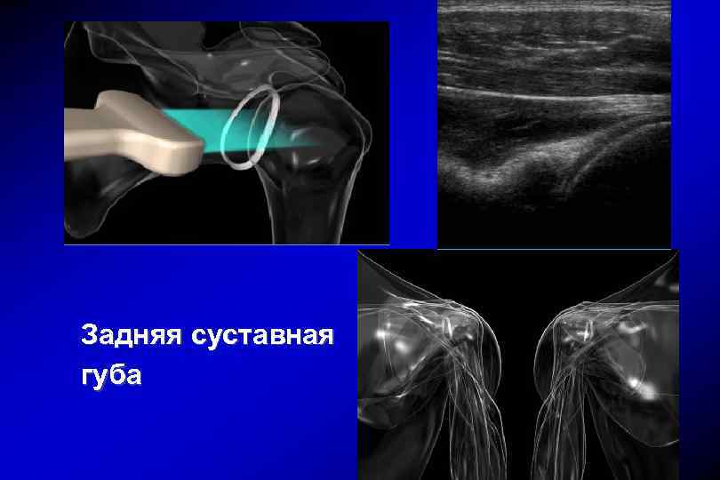 Суставная губа. Суставная губа плечевого сустава. Разрыв суставной губы плечевого сустава. Задняя суставная губа плечевого сустава. Разрыв задней суставной губы.