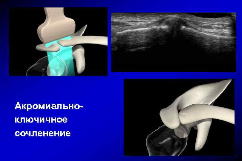 Акромиально ключичное сочленение норма. УЗИ ключично-акромиального сочленения. Артрит акромиально-ключичного сустава.