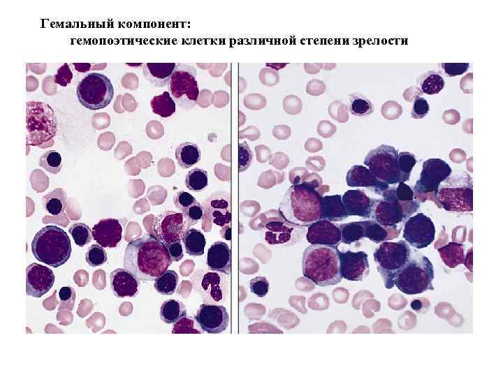 Гемальный компонент: гемопоэтические клетки различной степени зрелости 