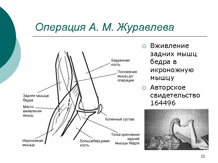 Операция А. М. Журавлева ¡ ¡ Вживление задних мышц бедра в икроножную мышцу Авторское