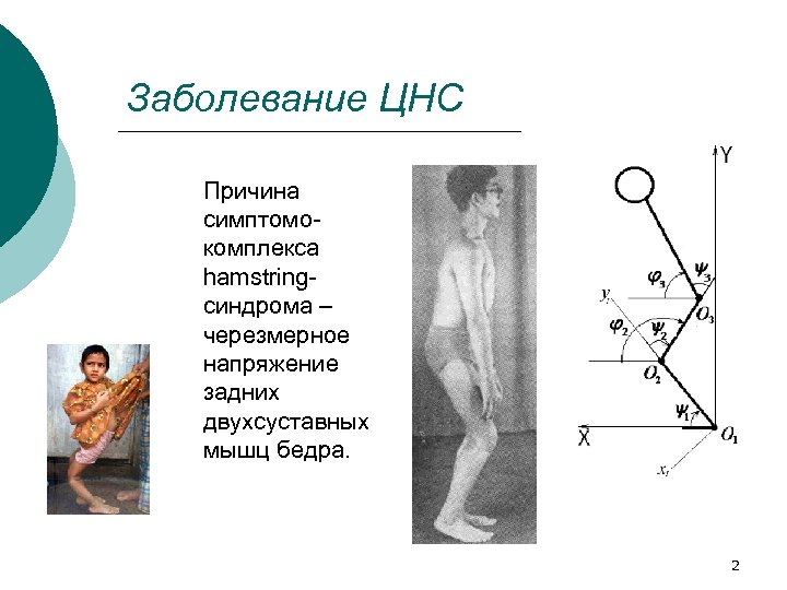 Заболевание ЦНС Причина симптомокомплекса hamstringсиндрома – черезмерное напряжение задних двухсуставных мышц бедра. 2 