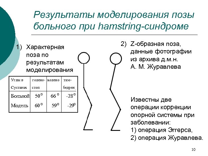 Результаты моделирования позы больного при hamstring-синдроме 2) Z-образная поза, данные фотографии из архива д.