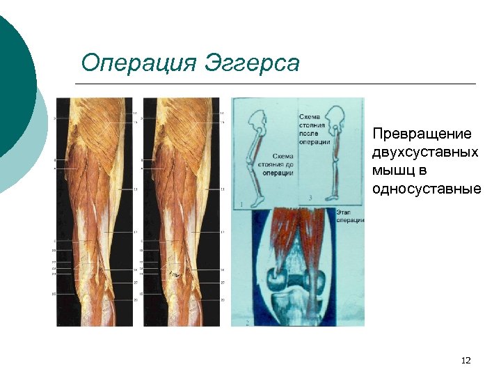 Операция Эггерса Превращение двухсуставных мышц в односуставные 12 