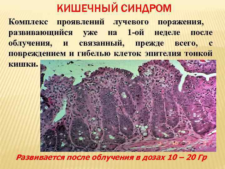 КИШЕЧНЫЙ СИНДРОМ Комплекс проявлений лучевого поражения, развивающийся уже на 1 -ой неделе после облучения,