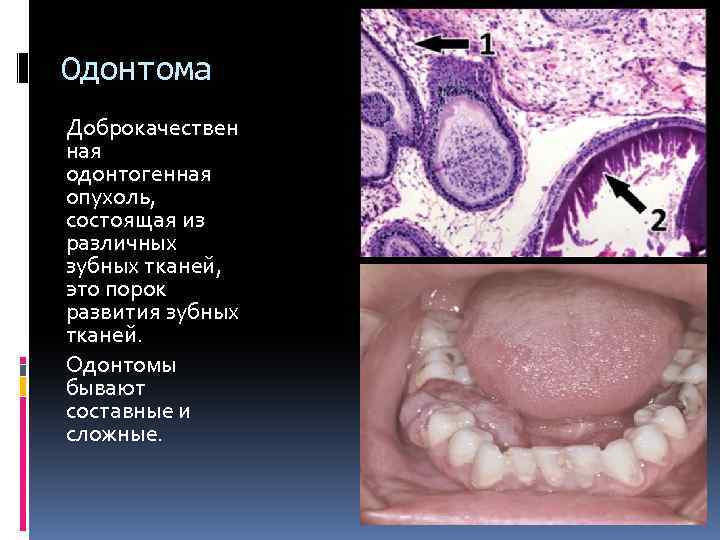 Одонтома Доброкачествен ная одонтогенная опухоль, состоящая из различных зубных тканей, это порок развития зубных