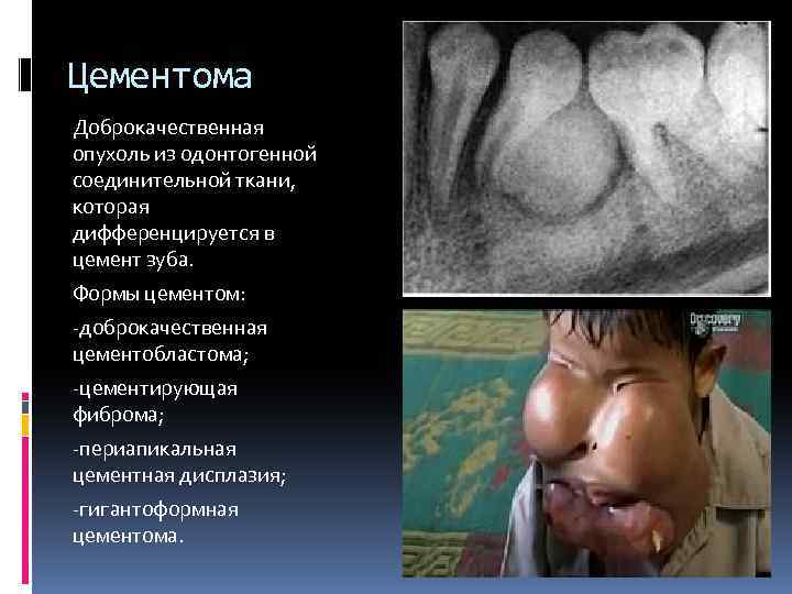 Цементома Доброкачественная опухоль из одонтогенной соединительной ткани, которая дифференцируется в цемент зуба. Формы цементом: