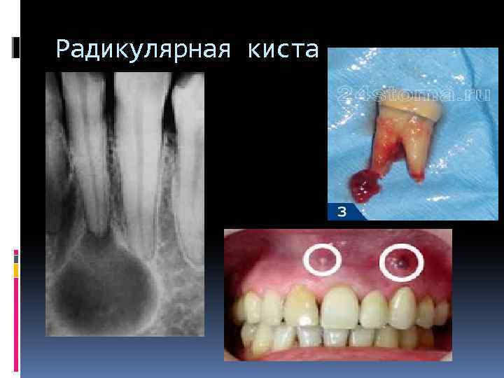 Радикулярная киста 