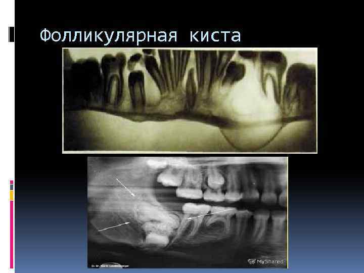 Фолликулярная киста 