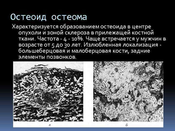 Остеоид остеома Характеризуется образованием остеоида в центре опухоли и зоной склероза в прилежащей костной