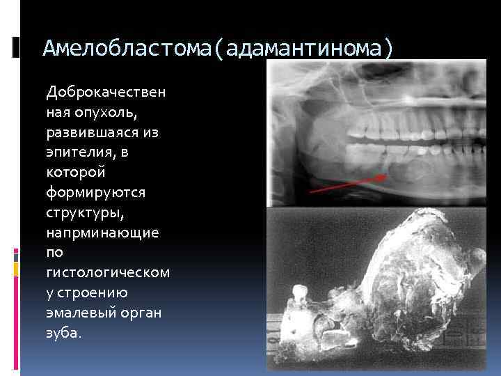 Амелобластома(адамантинома) Доброкачествен ная опухоль, развившаяся из эпителия, в которой формируются структуры, напрминающие по гистологическом