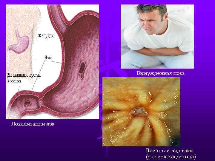 Вынужденная поза Локализации язв Внешний вид язвы (снимок эндоскопа) 