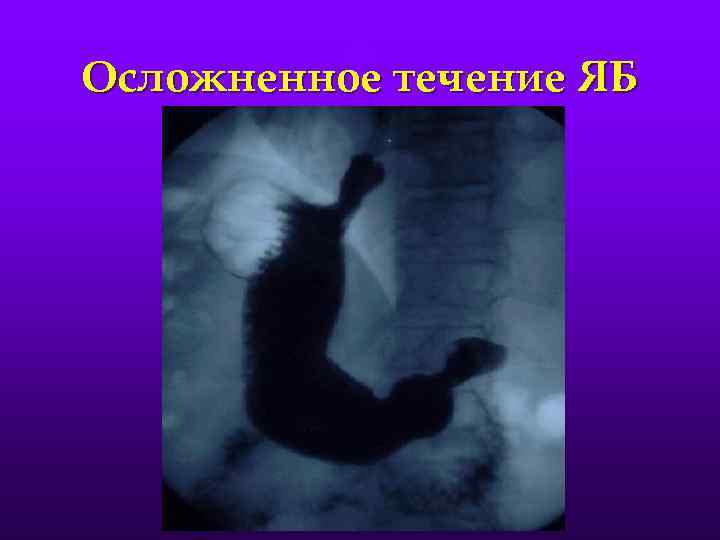 Осложненное течение ЯБ 