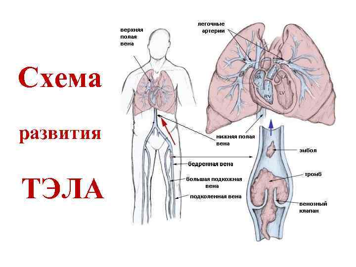 Схема развития ТЭЛА 