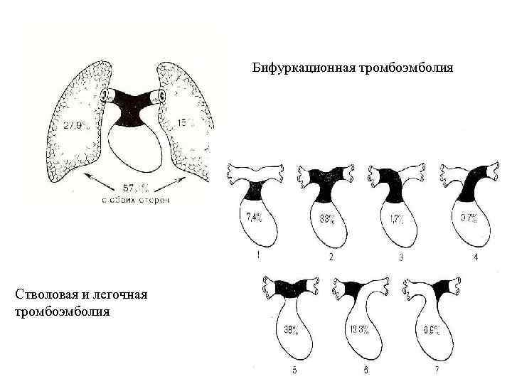 Бифуркационная тромбоэмболия Стволовая и легочная тромбоэмболия 