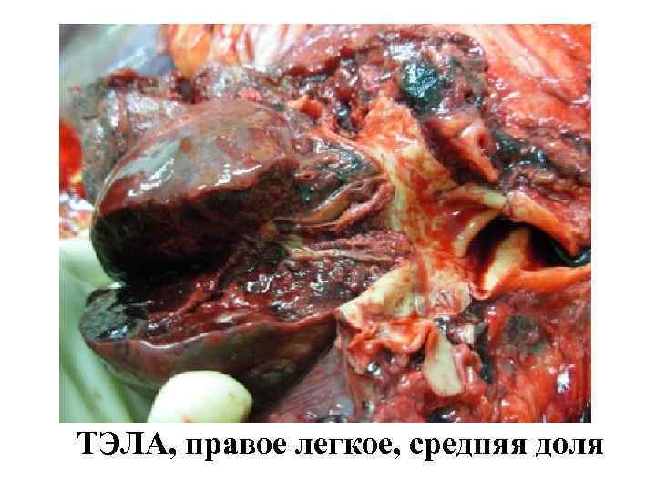 ТЭЛА, правое легкое, средняя доля 