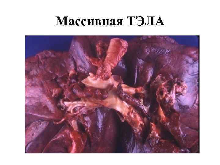 Массивная ТЭЛА 