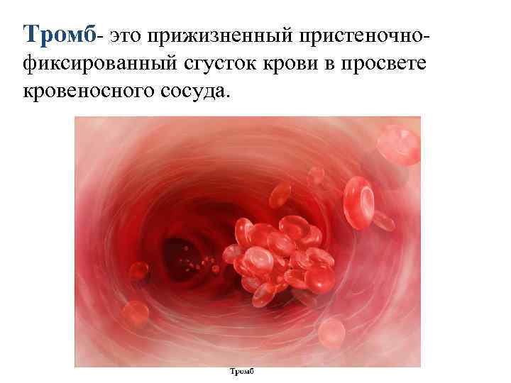 Тромб- это прижизненный пристеночнофиксированный сгусток крови в просвете кровеносного сосуда. 