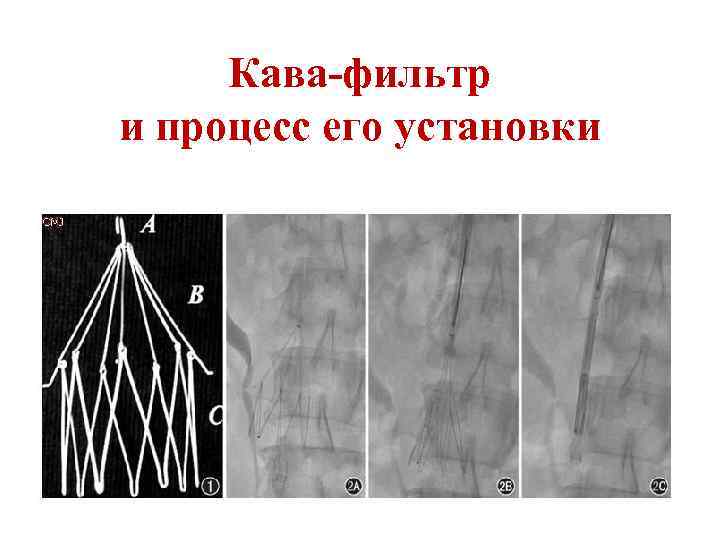 Кава-фильтр и процесс его установки 