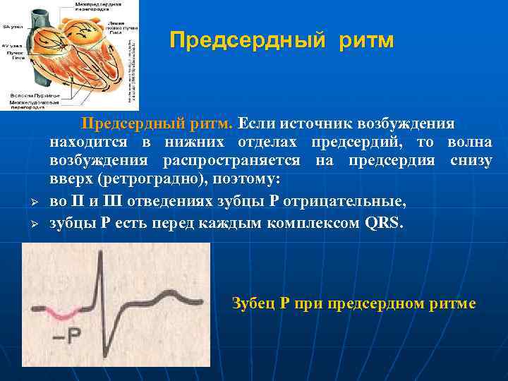 Предсердный ритм Ø Ø Предсердный ритм. Если источник возбуждения находится в нижних отделах предсердий,