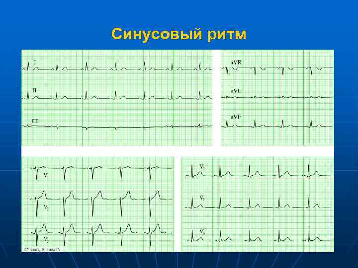 Синусовый ритм 