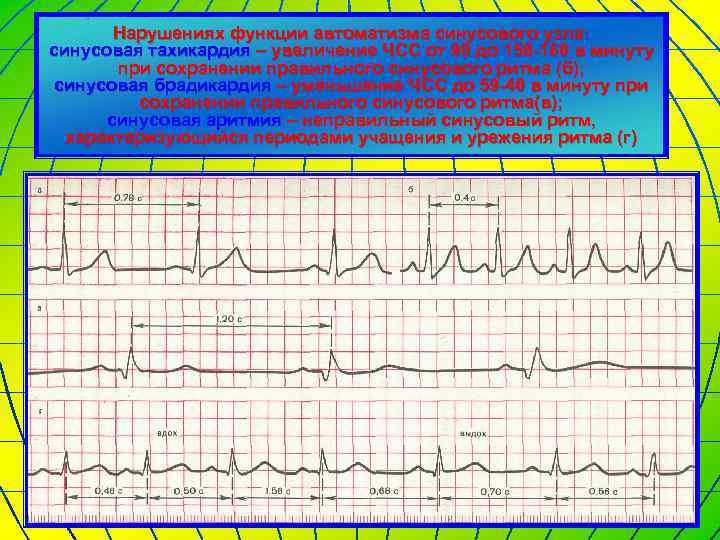Нарушениях функции автоматизма синусового узла: синусовая тахикардия – увеличение ЧСС от 90 до 150