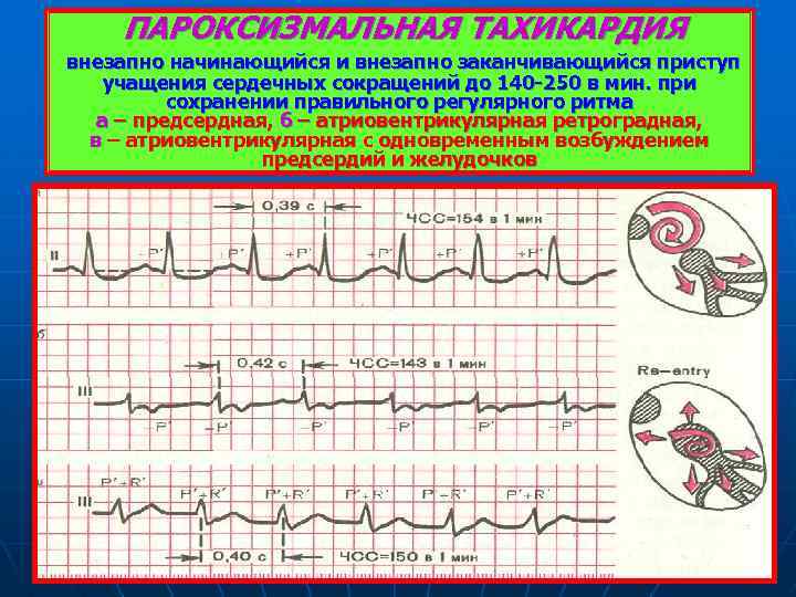 Пароксизмальная тахикардия презентация