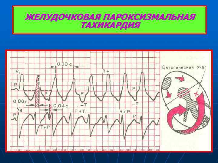 ЖЕЛУДОЧКОВАЯ ПАРОКСИЗМАЛЬНАЯ ТАХИКАРДИЯ 