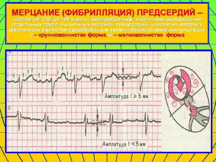 МЕРЦАНИЕ (ФИБРИЛЛЯЦИЯ) ПРЕДСЕРДИЙ – частое (от 350 до 700 в мин. ) беспорядочное, хаотичное